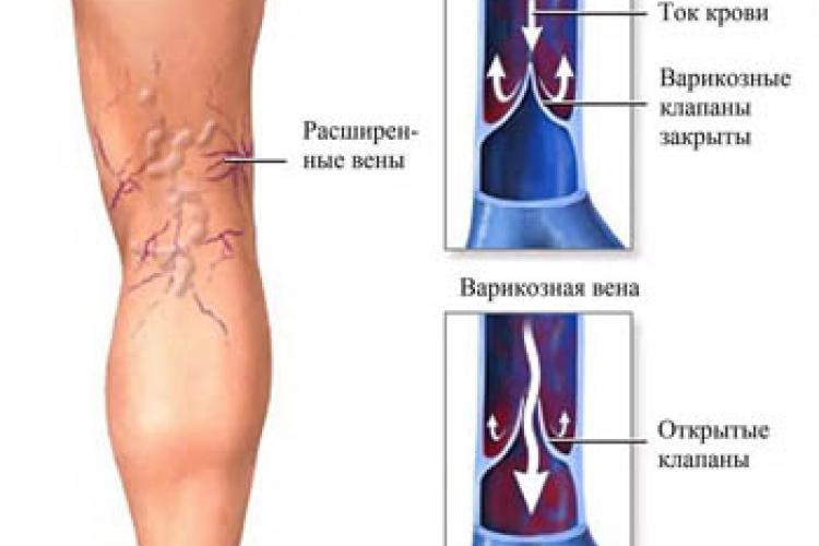 Как не запустить варикозную болезнь?